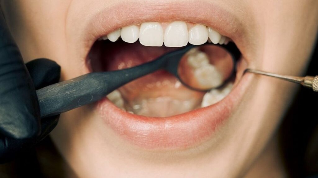 Preventing Gum Disease